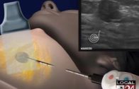 revolutionary-israeli-device-that-removes-breast-cancer-tumors-without-surgery